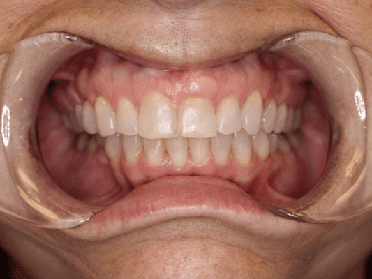 Invisalign After