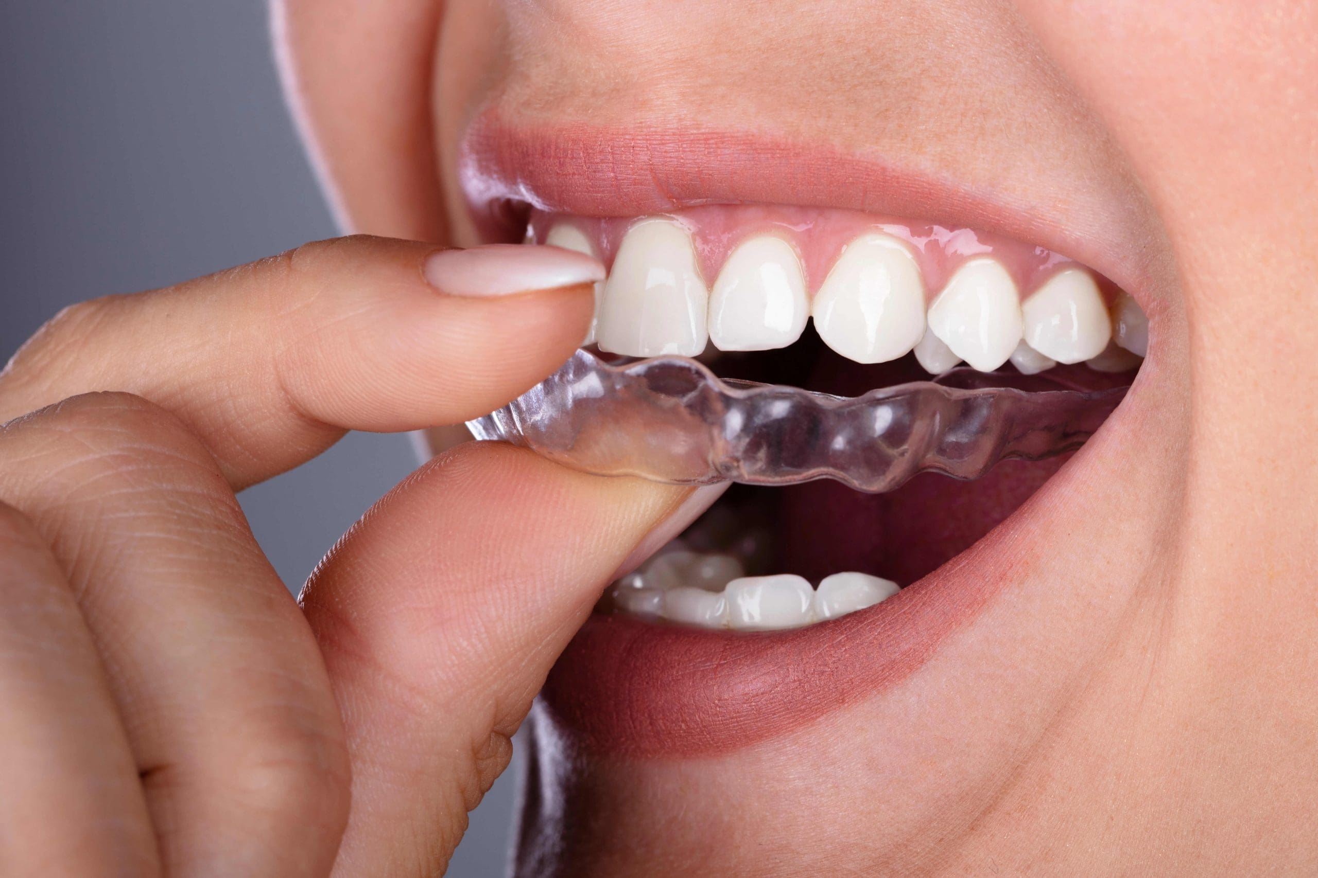 Do Aligners Work? A Comprehensive Guide to Their Effectiveness